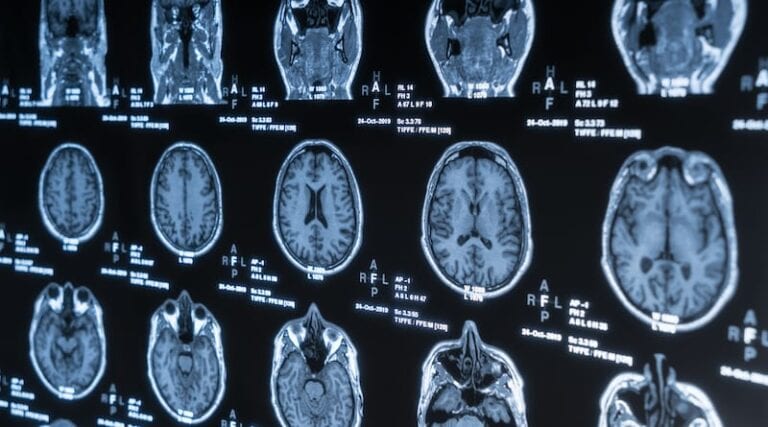mri