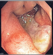 Obraz endoskopowy głębokiego wrzodu żołądka. 