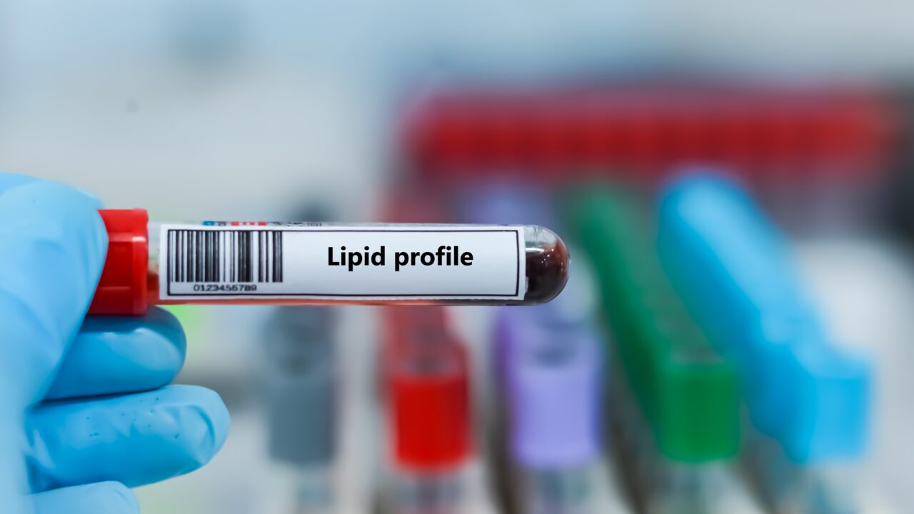 Probówka z próbką krwi do analizy profilu lipidów